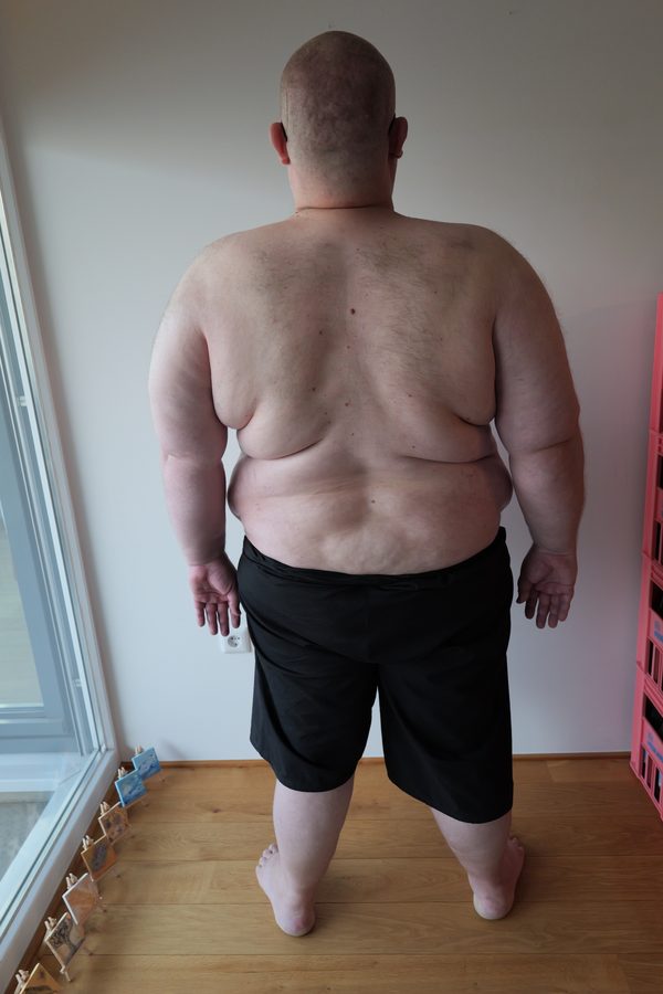 Day 0 back view
